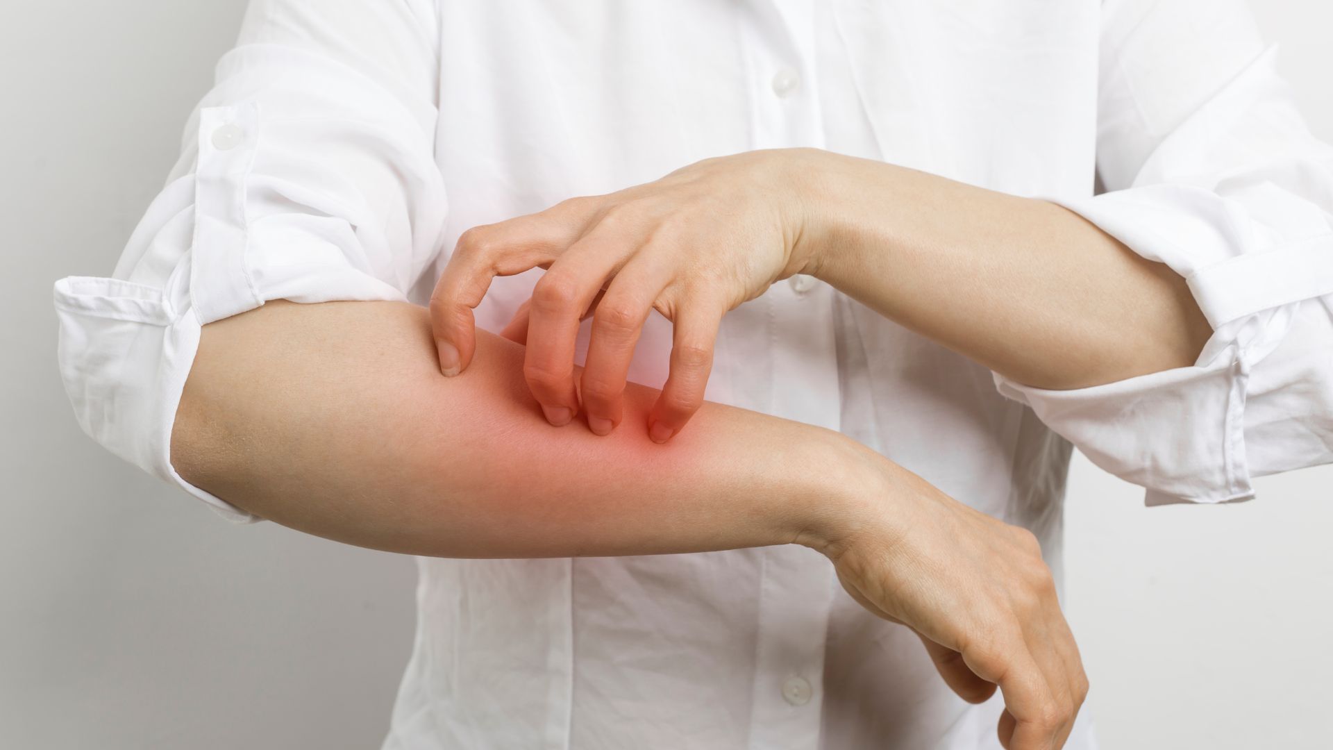 Adulto com sinais de cutâneos de alergia